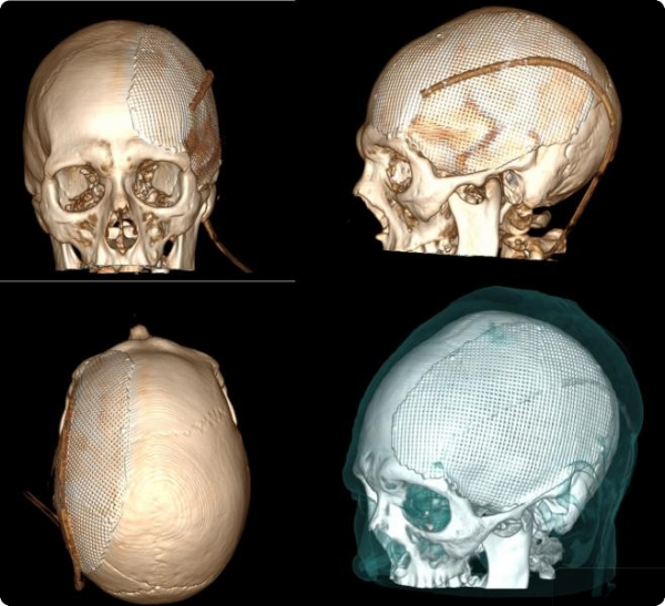 Тагильские врачи спасли мужчину, который получил переломы черепа в результате аварии 0